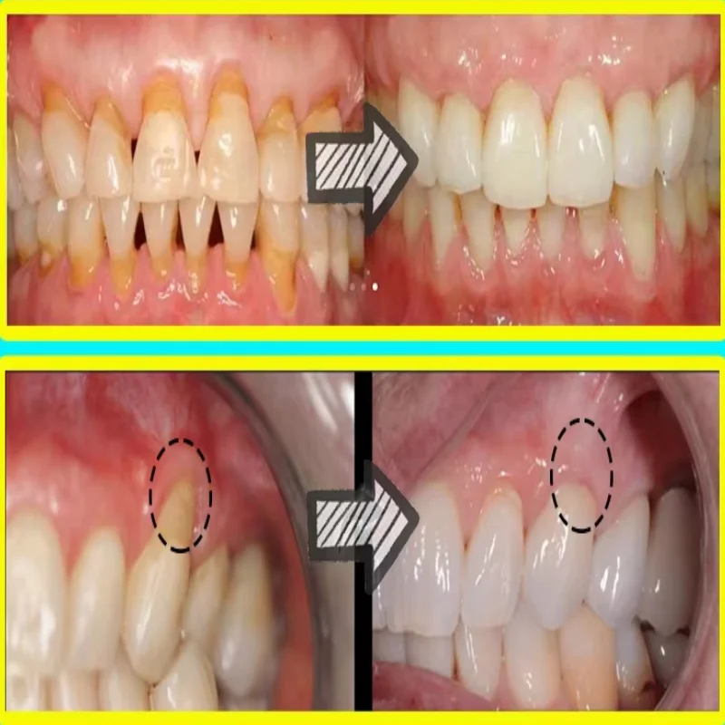 Snel Reparatie Tandvlees Serum - Teeth Whitening Baking Soda recensie en prijs