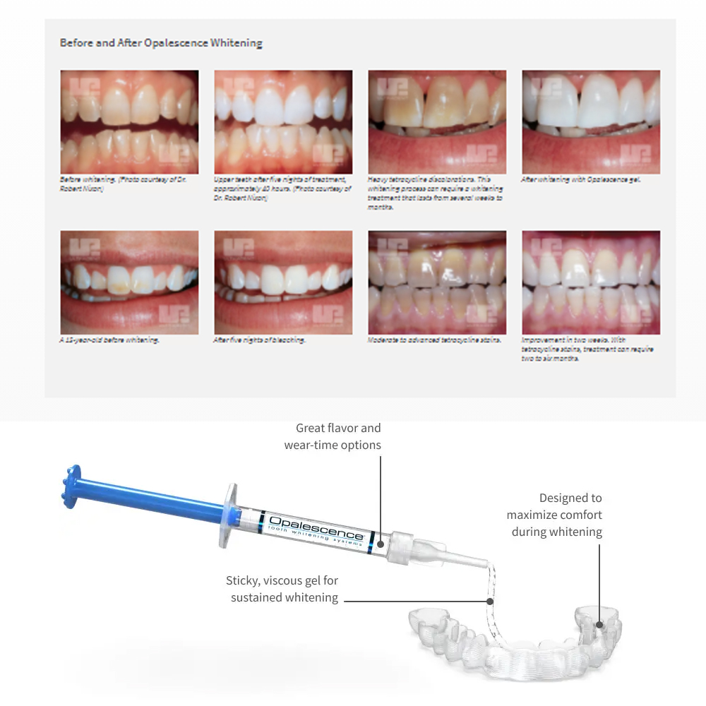 Opalescentie Whitening 20% Pf  - Teeth Whitening Gels Used By Dentists recensie en prijs