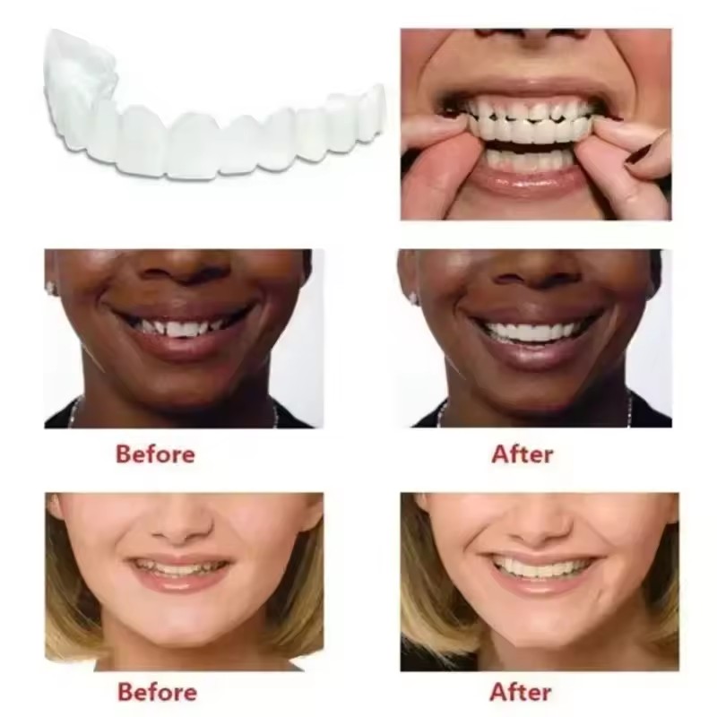 Tanden Veneers Bleekmiddelen P - Teeth Whitening Kit recensie en prijs