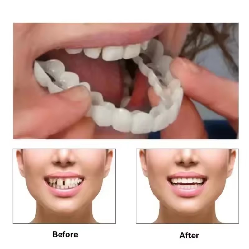 Tanden Veneers Bleekmiddelen P - Teeth Whitening Kit recensie en prijs