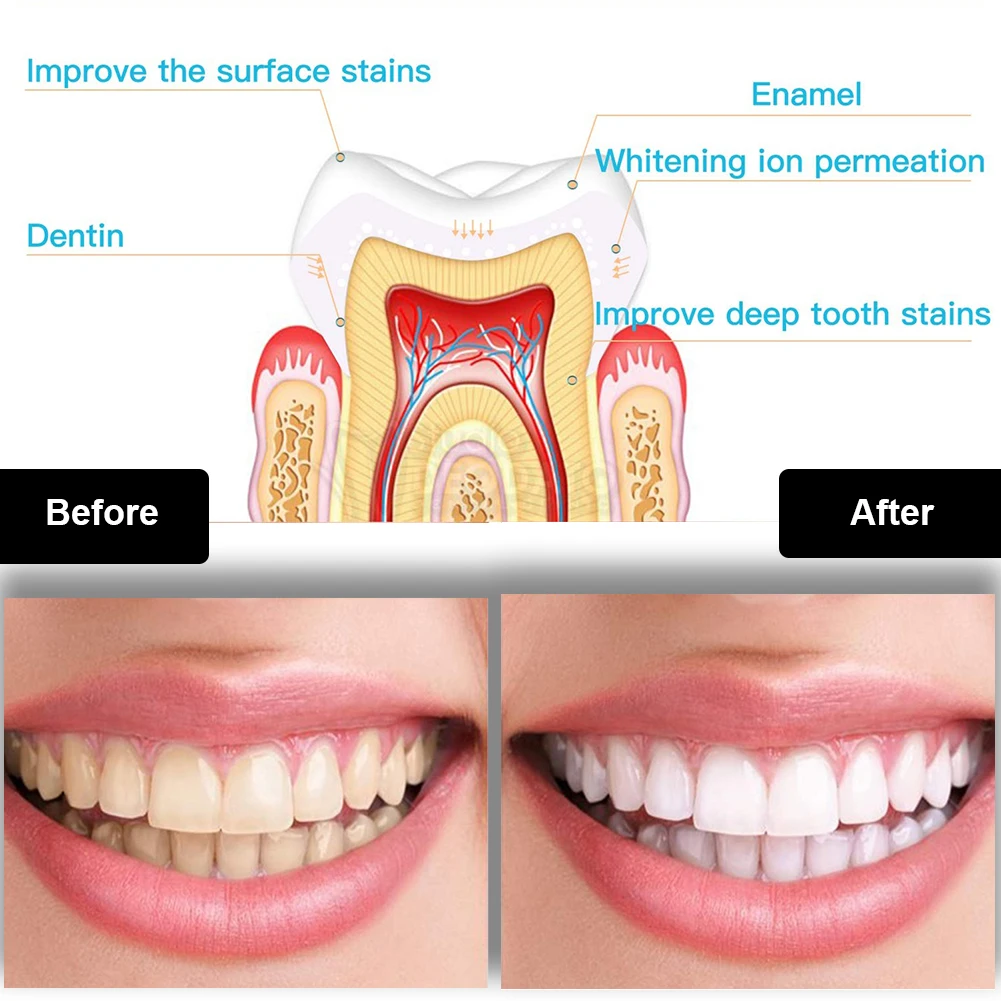 Tandheelkundige Tanden Whiteni - Teeth Whitening Gel Peroxide recensie en prijs